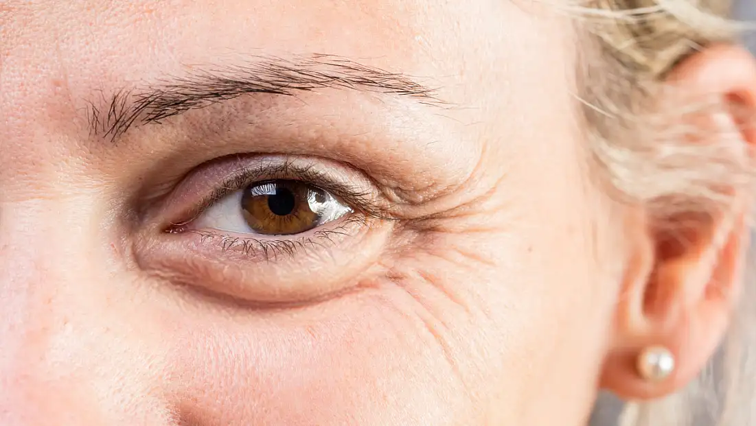 Göz Çevresi Kırışıklıklarına Çözüm: Kaz Ayağı Botoksu