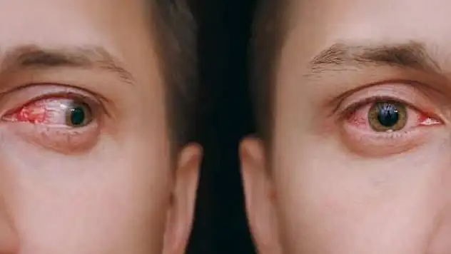 Omicron'un iki yeni 'garip' semptomu ortaya çıktı