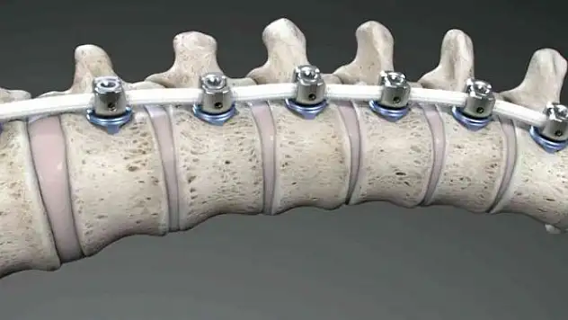 Skolyoz tedavisinde artık eğriliğin düzeltilmesi mümkün!