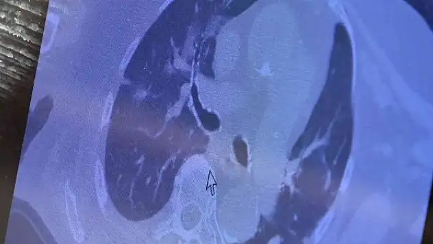 Kovid-19'da yeni hasta profili: 'Aşı oldum hastalandım'