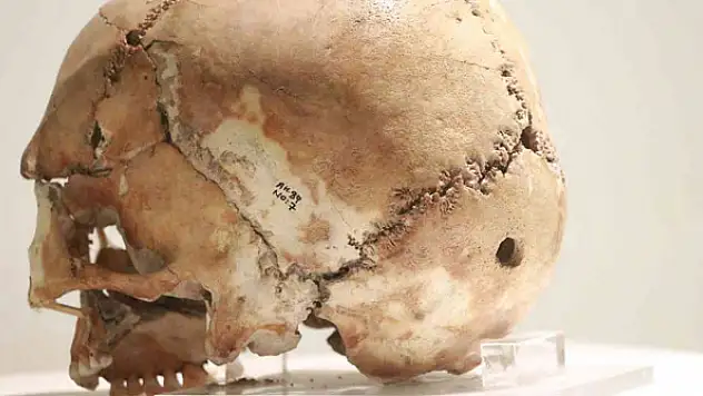 Dünyanın ilk beyin ameliyatı binlerce yıl önce Aksaray'da yapıldı