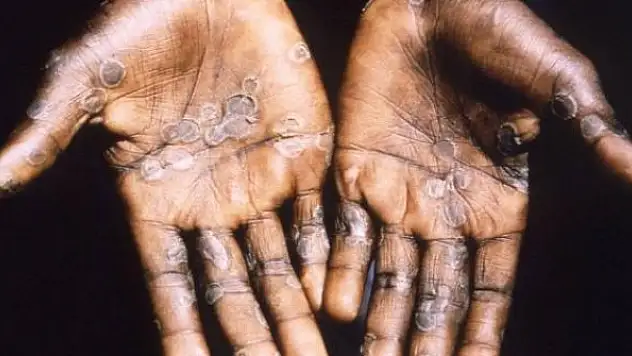 Maymun çiçeği virüsü bir ülkede daha görüldü