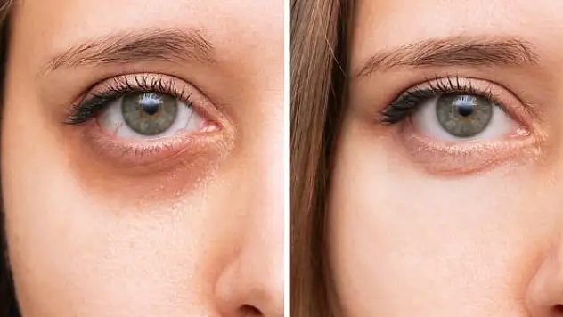 Uzmanı uyardı: Gözaltındaki mor halkalar basit bir cilt problemi olmayabilir