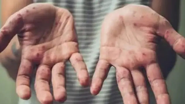 TTB'den 'maymun çiçeği hastalığı' açıklaması