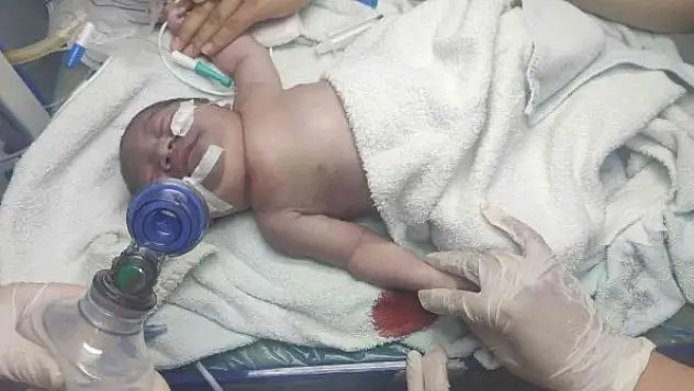 Yeni doğan bebeğin köprücük kemiği kırıldı, vücudu mosmor oldu