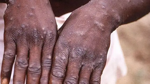 Dr. Alver: Maymun çiçeğinin ölüm oranı düşük