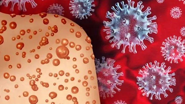 Maymun çiçeği virüsünden ilk ölüm kayıtlara geçti