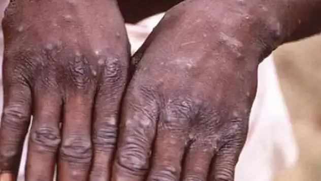 Maymun çiçeği virüsü bir ülkede daha görüldü