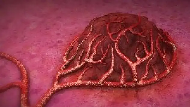 Kolon kanserinde 'kürecik' mucizesi