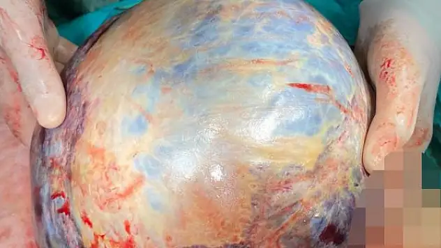 Nefes darlığı şikayetiyle gittiği hastanede karnından 10 kilo tümör çıkarıldı