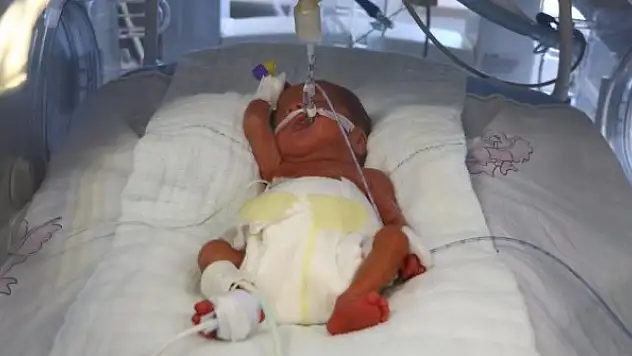 Tekirdağ'da 23 haftalık doğan bebeğe kök hücre nakli yapıldı