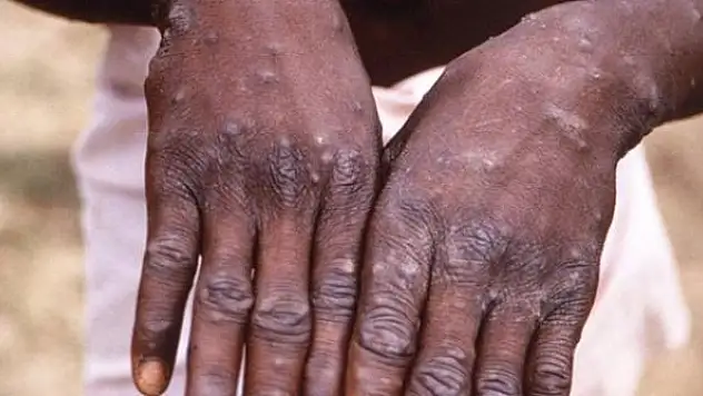 Tayland'ın ilk maymun çiçeği vakası Kamboçya'ya kaçtı