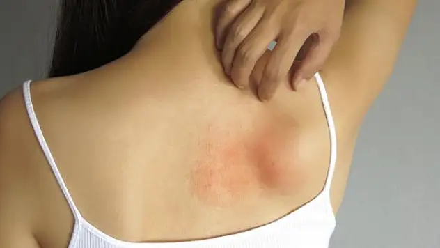 Alerjinizi iyi tanıyın!