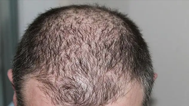 Genç yaşta saç kayıpları engellenebilir mi?