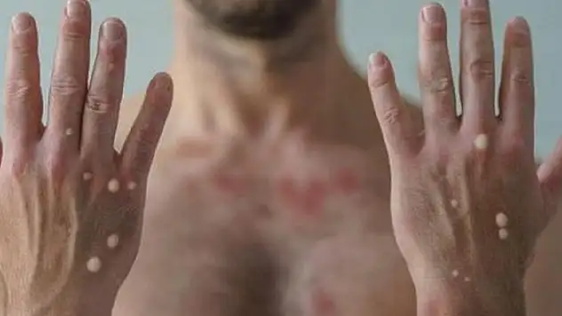 Maymun çiçeğinin okulların açılmasıyla çocuklar arasında yayılabileceği öngörülüyor