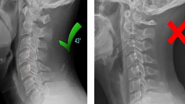 Boyun düzleşmesine karşı uzmanından uyarı