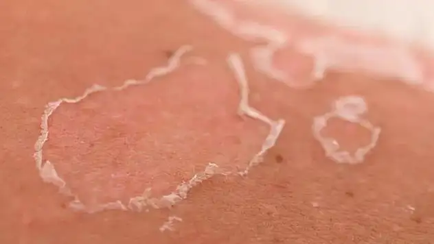 Güneş yanığında sakın bunları yapmayın!