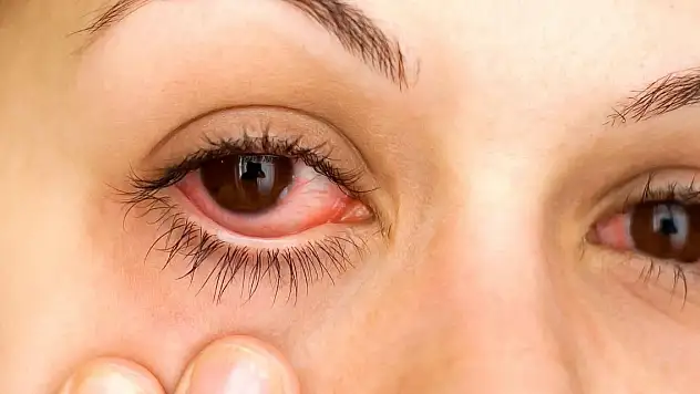 Gözleriniz kızarıyorsa dikkat!