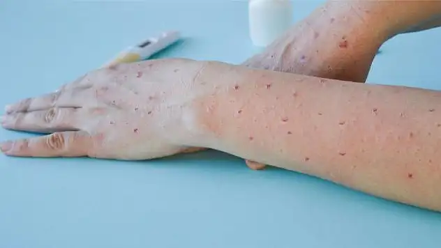 Hollanda'da maymun çiçeği virüsü vaka sayısı bini aştı