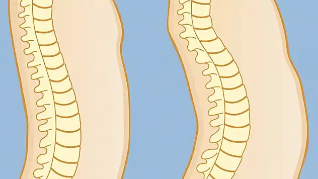Kamburluğu (kifoz) önlemenin 8 altın kuralı