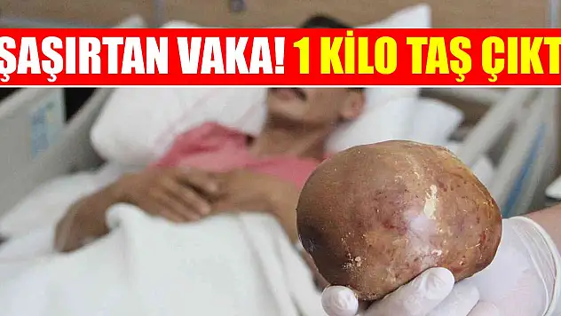 Şaşırtan vaka! Hastaneye başvuran hastanın mesanesinden 1 kilo taş çıktı