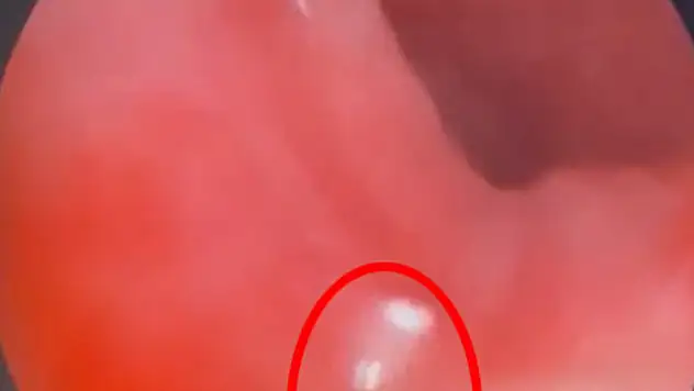 Nefes borusundan canlı sinek larvaları çıktı