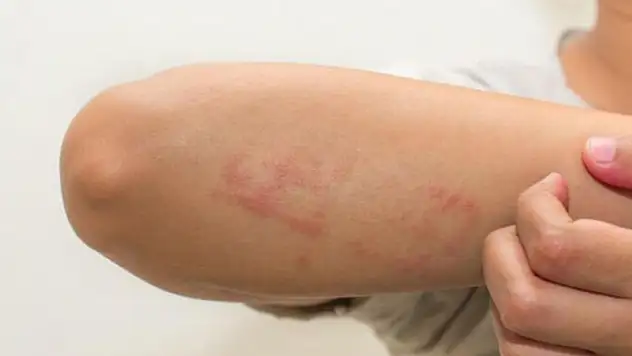 Uzmanı uyardı: Glüten alerjisi bu yaşlarda daha sık görülüyor