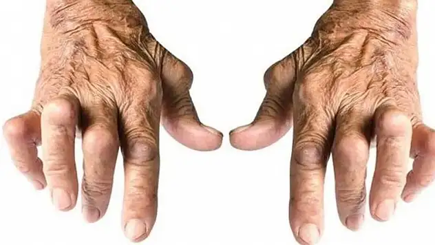 Bu hastalık en çok ellerimizden vuruyor! 40'lı yaşlardan sonra tavan yapıyor