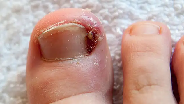 Tırnak batmasını önlemek için 5 kritik öneri