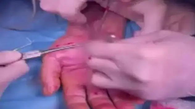 Bu defa hastanın eli içinde odun parçası unutuldu