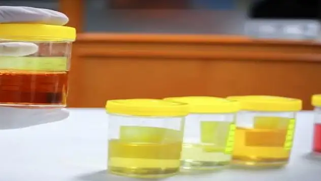 İdrar rengine dikkat !