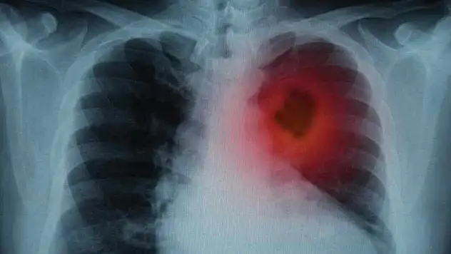 Bu kanser türü erkeklerde daha sık görülüyor