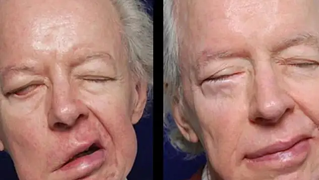 İhmal etmeyin! Yüz felcine dikkat