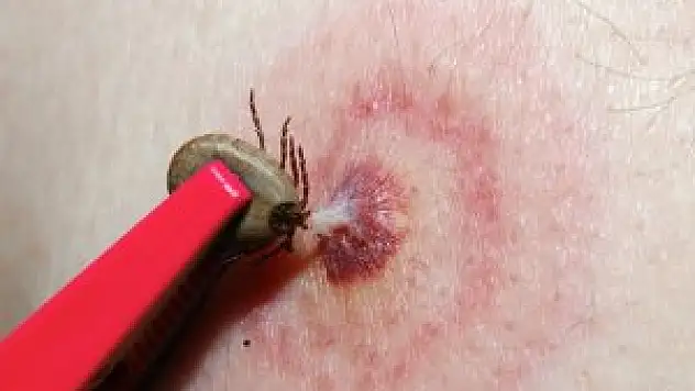 Sivas'ta KKKA hastalığı şüphesi