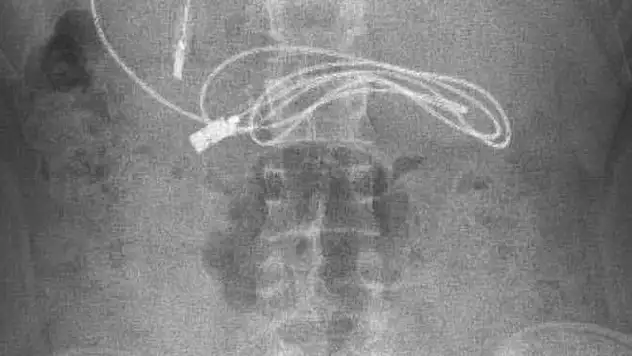 Kusma ve karın ağrısı şikayetiyle doktora gitti, karnından şarj kablosu çıktı