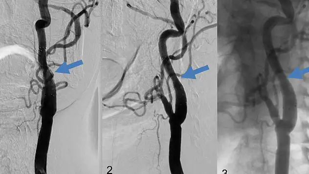Tıkalı şah damarı kalıcı felcin habercisi olabilir