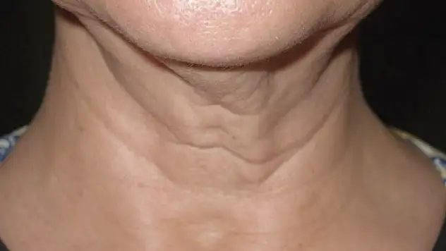 Vücuttaki kırışıklık ve sarkmalar neden kaynaklanır?