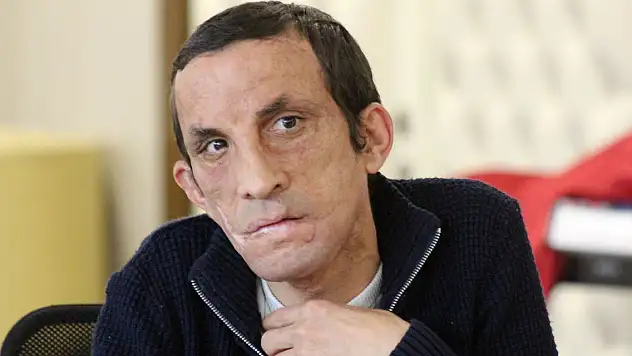 Türkiye'nin ilk yüz naklinin üzerinden 11 yıl geçti