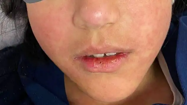 Pandemi etkili oldu, yıllardır görülmeyen vakalar yeniden ortaya çıktı