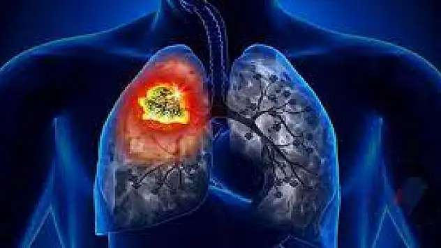 Akciğer kanserinin 8 belirtisi