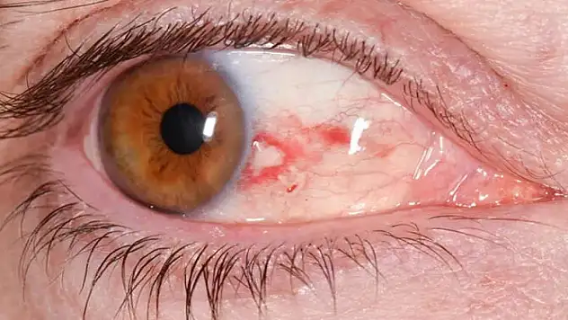 Göz tansiyonu (Glokom) nedir, nasıl oluşur, nelere dikkat edilmeli?