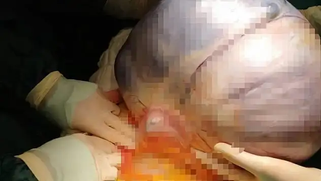 Karın ağrısı yaşayan 89 yaşındaki hastadan 35 santimetrelik kitle çıktı