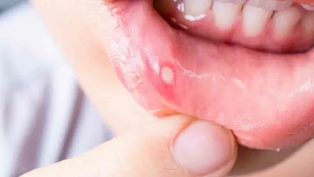 Sık kullanılan ağız gargaraları bu hastalığa sebep olabilir
