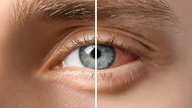 Gözlerde Geçmeyen Kızarıklığın Altında Üveit Yatıyor Olabilir!