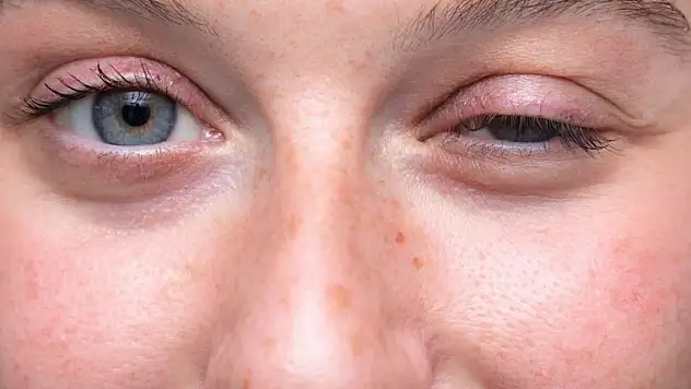 Bu hastalığın adı sizi korkutmasın!  Tedavisi mümkün