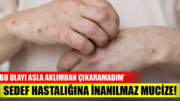 Sedef hastalığına inanılmaz mucize! 'Bu olayı asla aklımdan çıkaramadım'