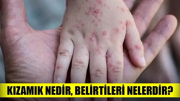 Kızamık nedir, belirtileri nelerdir?