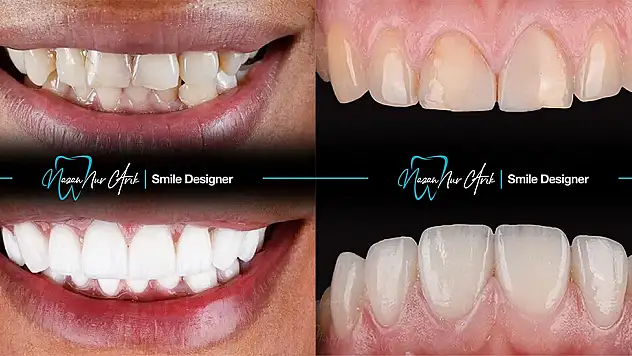 Diş Beyazlatma Nasıl Bir İşlemdir?