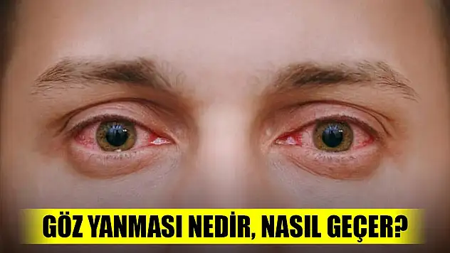 Göz yanması nedir, nasıl geçer?