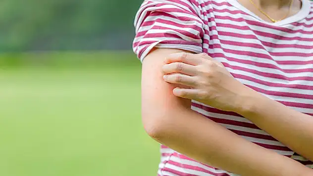 Sivrisinek ısırığına ne iyi gelir, nasıl geçer?